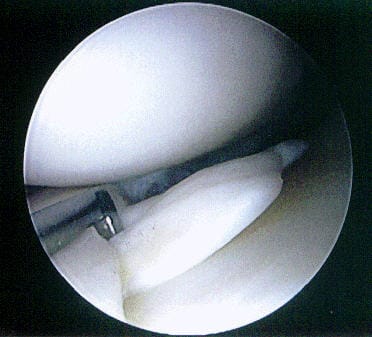 Arthroskopie des Kniegelenkes